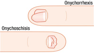 Onychoschisis und Onychorrhexis in einem Bild erklärt