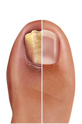 Darstellung eines Fußnagels mit einer gesunden Seite und eine Seite mit Nagelpilz