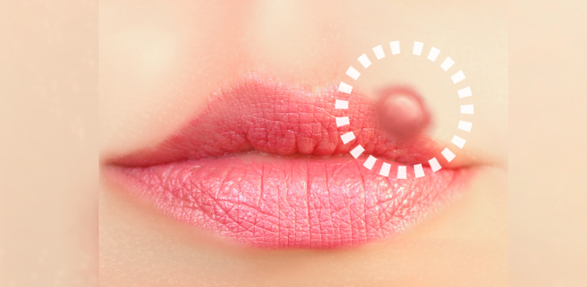 Lippenherpes Infografik