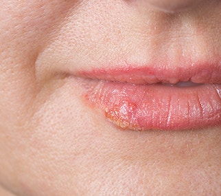 lippenherpes am mund